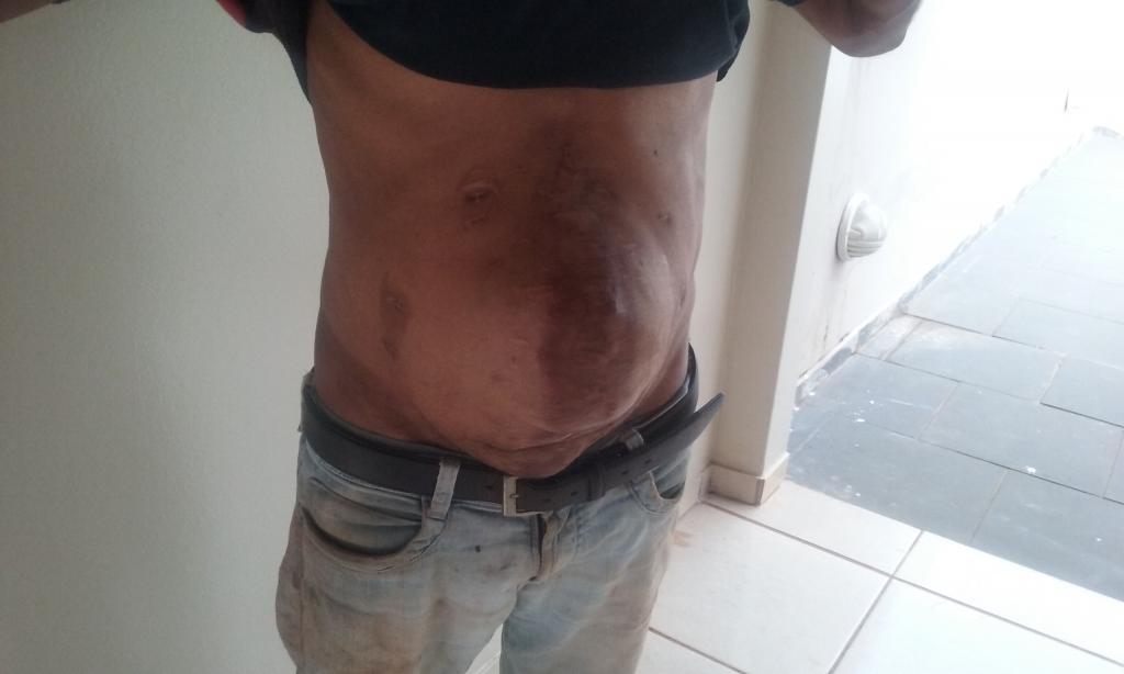 Costa Rica: Homem com hérnia pede socorro