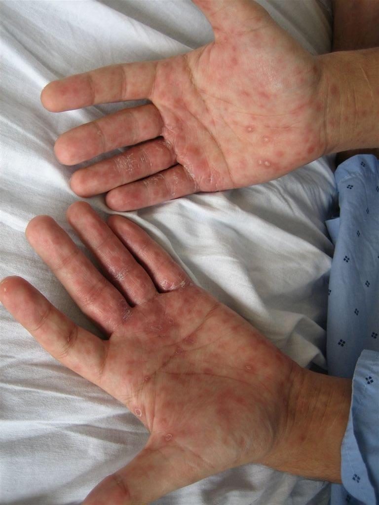 A sífilis causa inflamações pelo corpo.