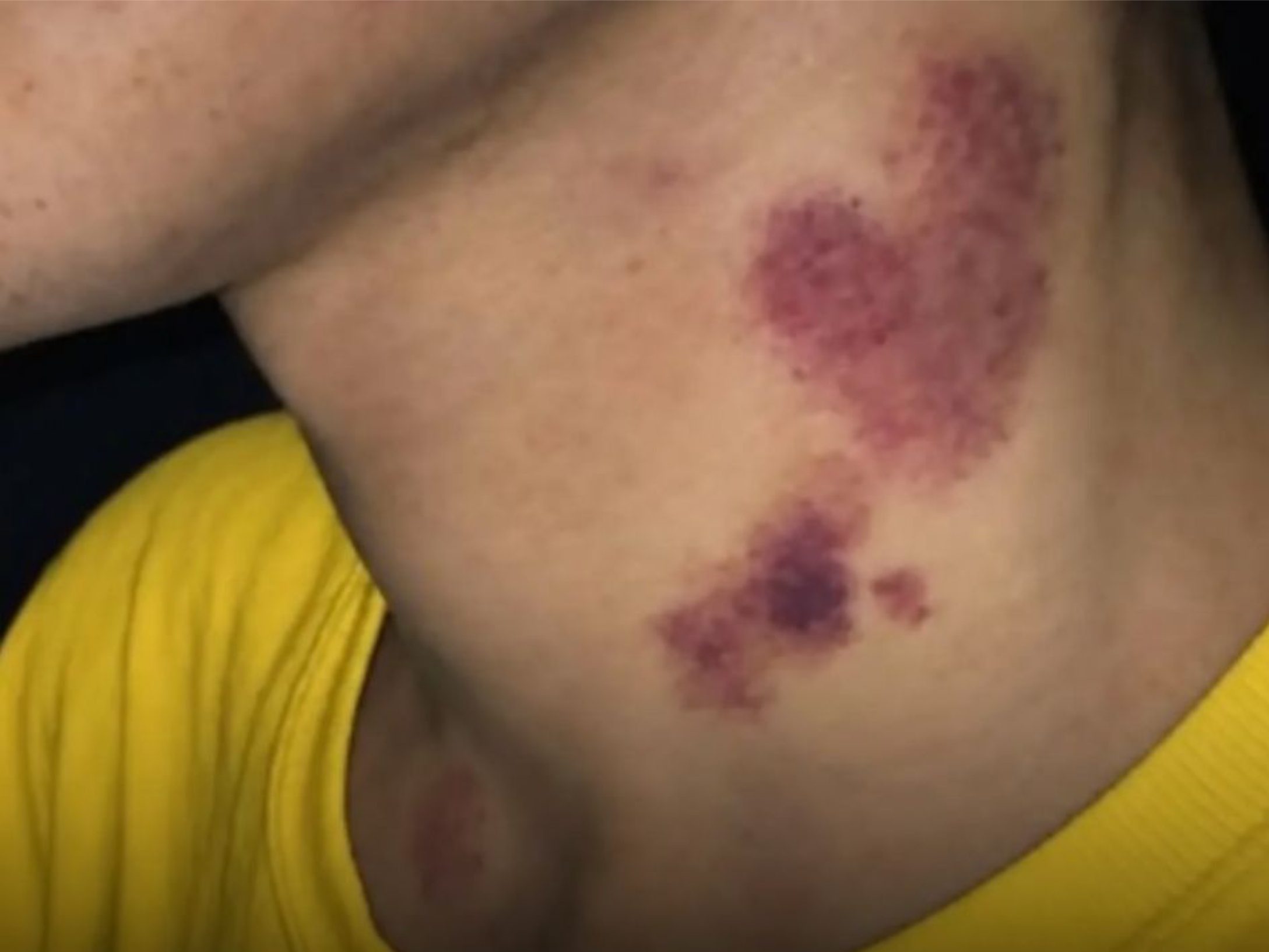CHUPÃO NO PESCOÇO: CASO RARO ACENDE ALERTA SOBRE OS RISCOS À SAÚDE