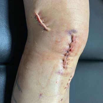 Foto de um joelho pós operado 
