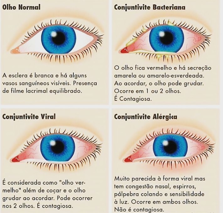 Os tipos de conjuntivite