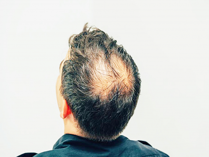 Perda de cabelo é o atributo físico que mais afeta a autoestima