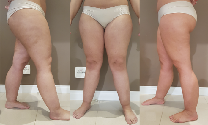Hormônios x Lipedema x Celulite: médicos explicam qual a relação e a diferença da doença com a celulite