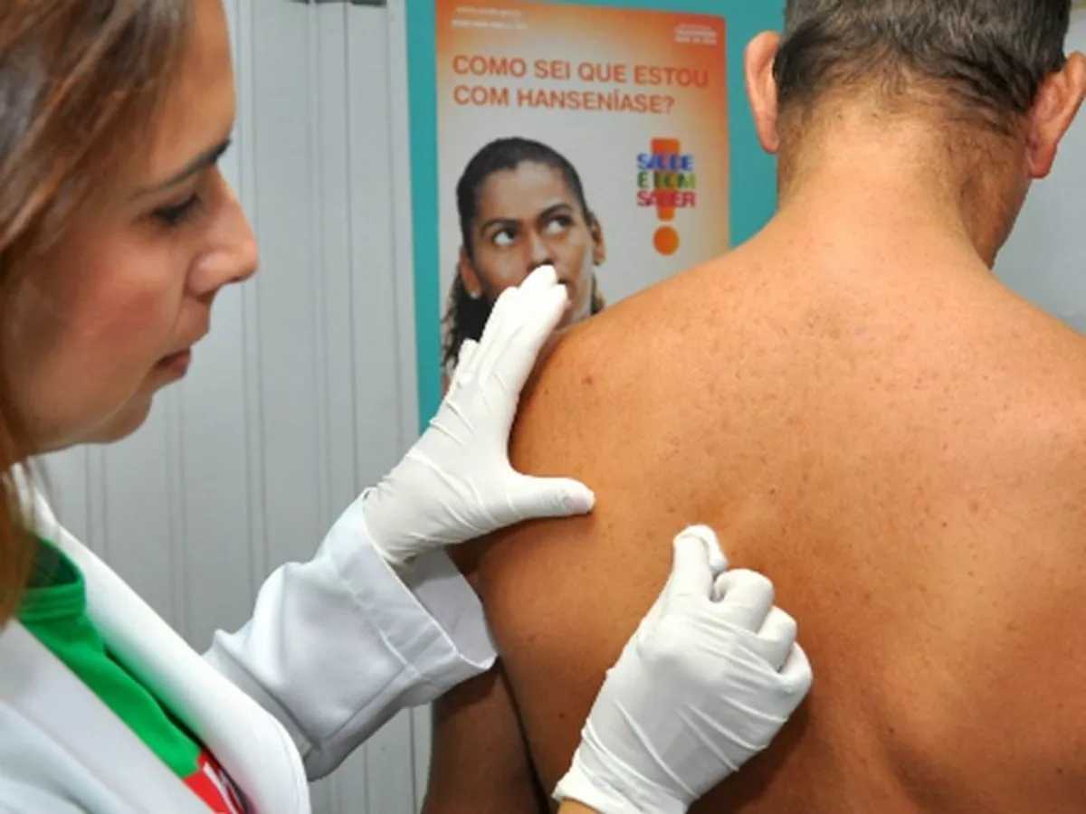 30 de janeiro: Dia Nacional de Combate e Prevenção da Hanseníase