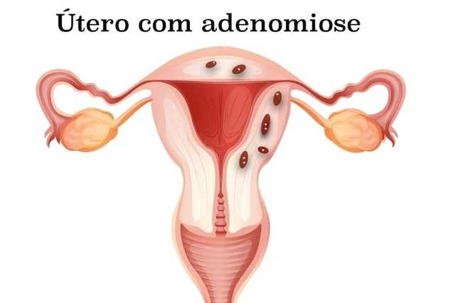 Confundida com a Endometriose, Adenomiose pode causar infertilidade e perdas gestacionais em mulheres jovens