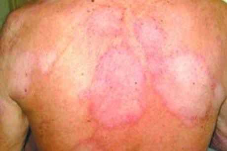 Janeiro Roxo alerta para endemia oculta de hanseníase no Brasil