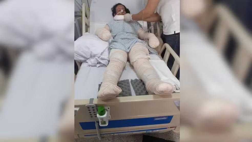 Internações na Unidade de Tratamento de Queimados aumentam 65% neste ano em hospital referência para Jales e todo o noroeste paulista